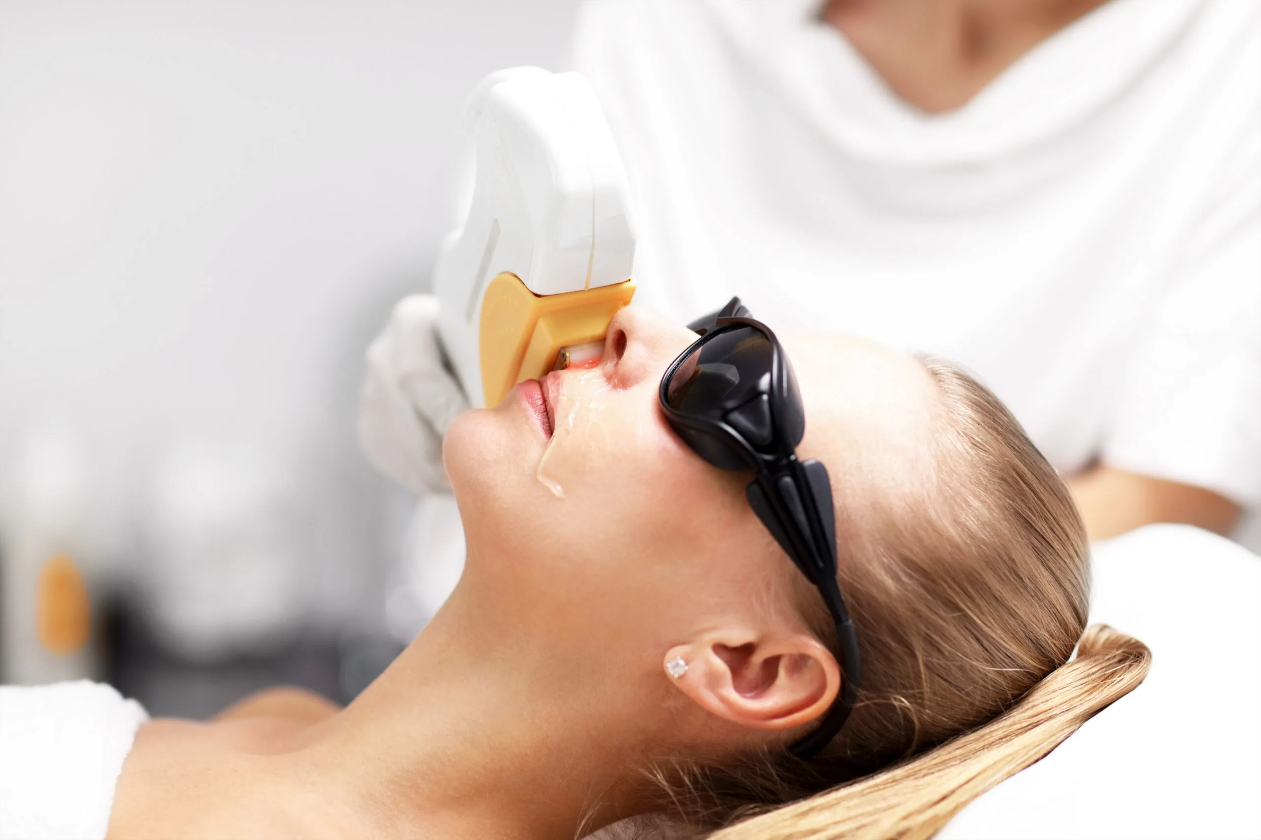 Depilación láser facial